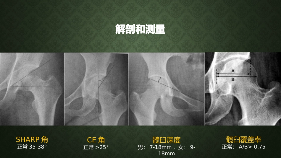 DDH的分型浅析_第3页