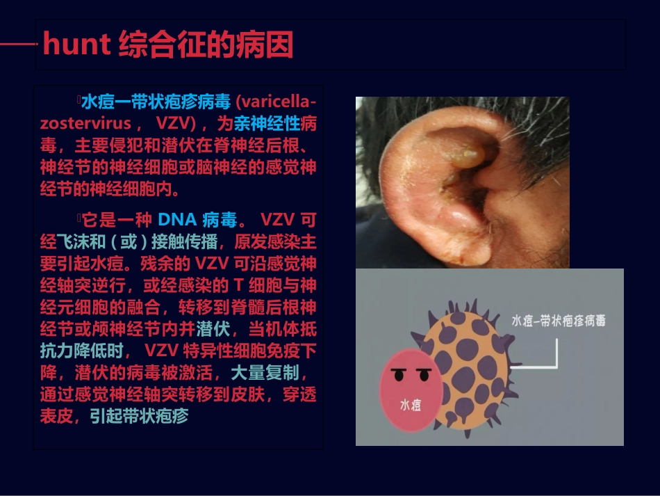hunt综合征耳带状疱疹_第3页
