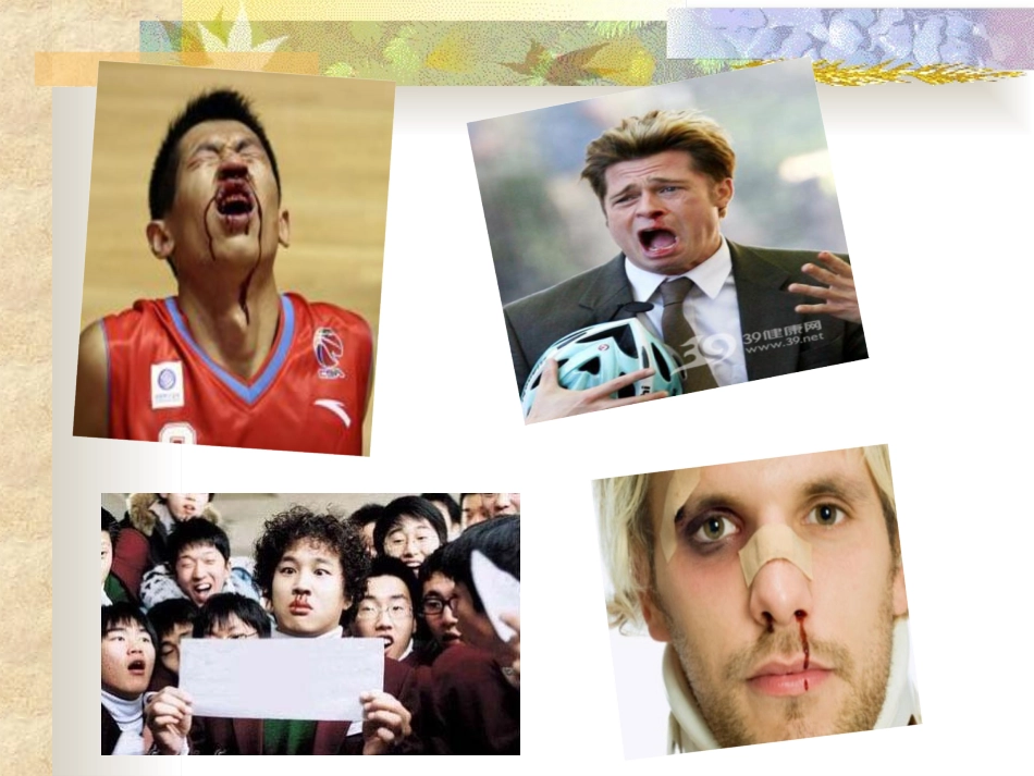 鼻出血的护理_第2页