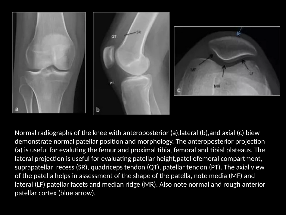 髌骨病变的影像学表现_第1页