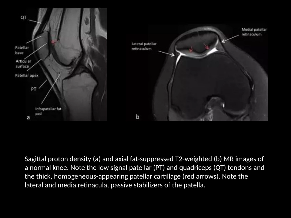 髌骨病变的影像学表现_第2页