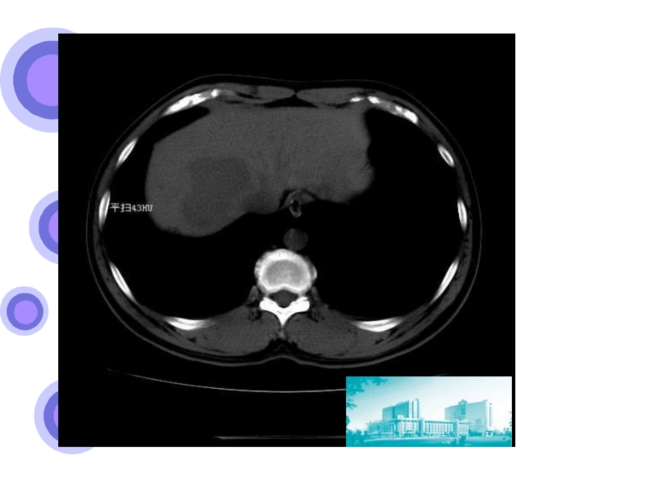 病例讨论肝占位_第3页