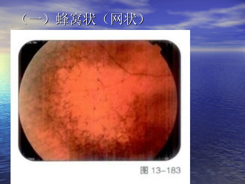 Kanski鉴别诊断周边视网膜变性_第3页