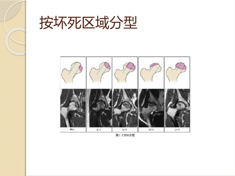 PRP减压保髋_第3页