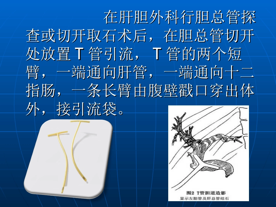 T管引流护理_第2页