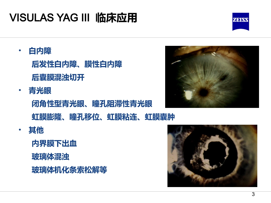 YAG激光临床应用_第3页