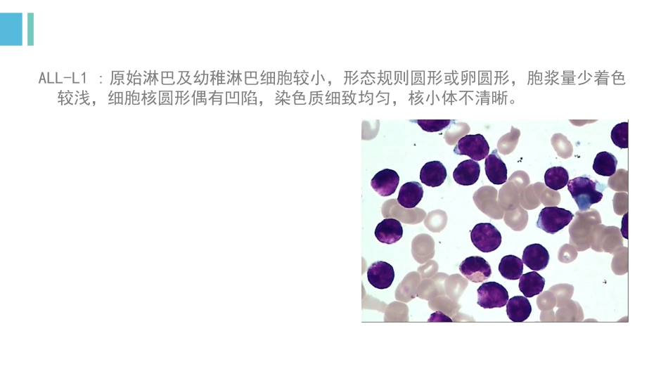 白血病骨髓图片_第3页