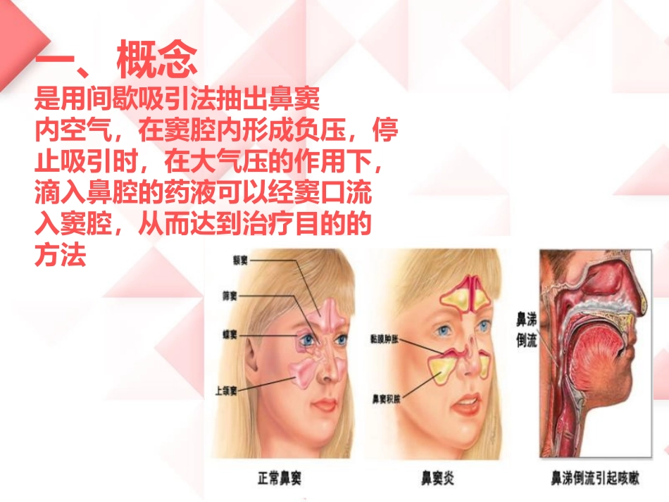 鼻负压置换的操作_第3页