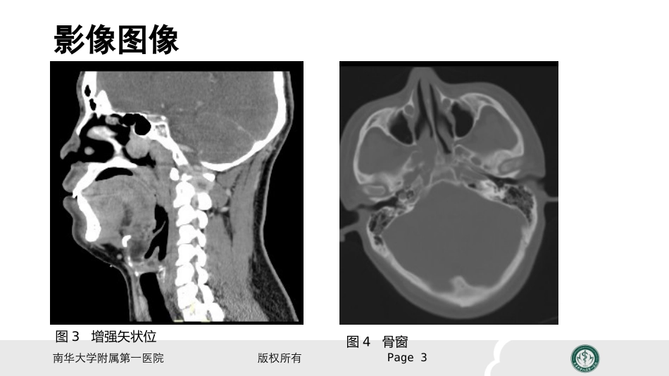 鼻咽纤维血管瘤的影像表现及临床_第3页