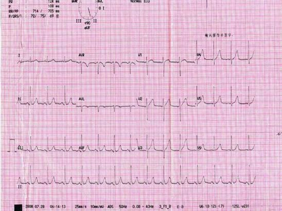 变异型心绞痛修改版_第3页