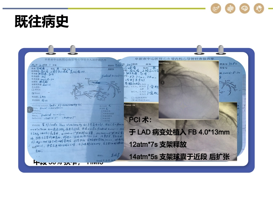 病例讨论急性心肌梗死合并室速_第3页