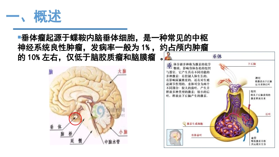 垂体瘤的护理_第3页