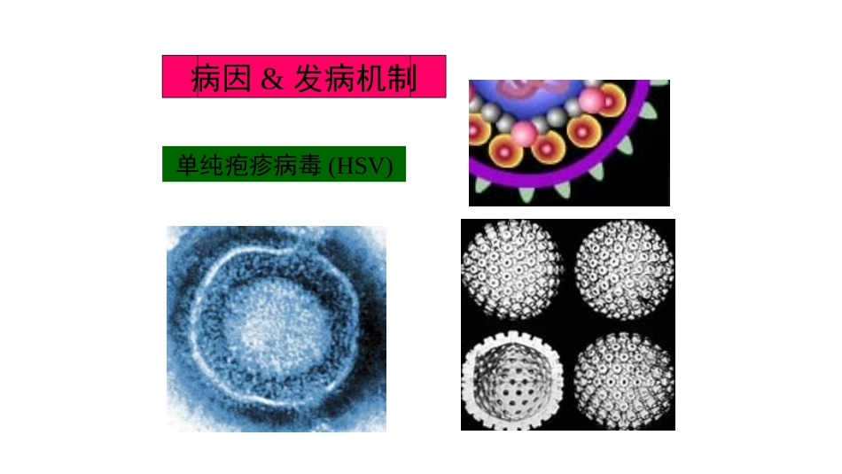 单纯疱疹病毒性脑炎_第1页