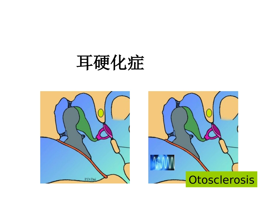 耳硬化症课件_第1页