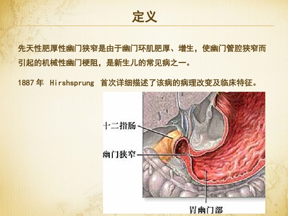 肥厚性幽门狭窄_第2页