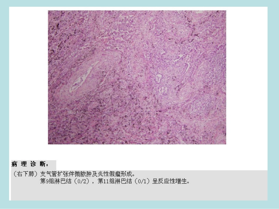 肺内结节的CT诊疗_第3页