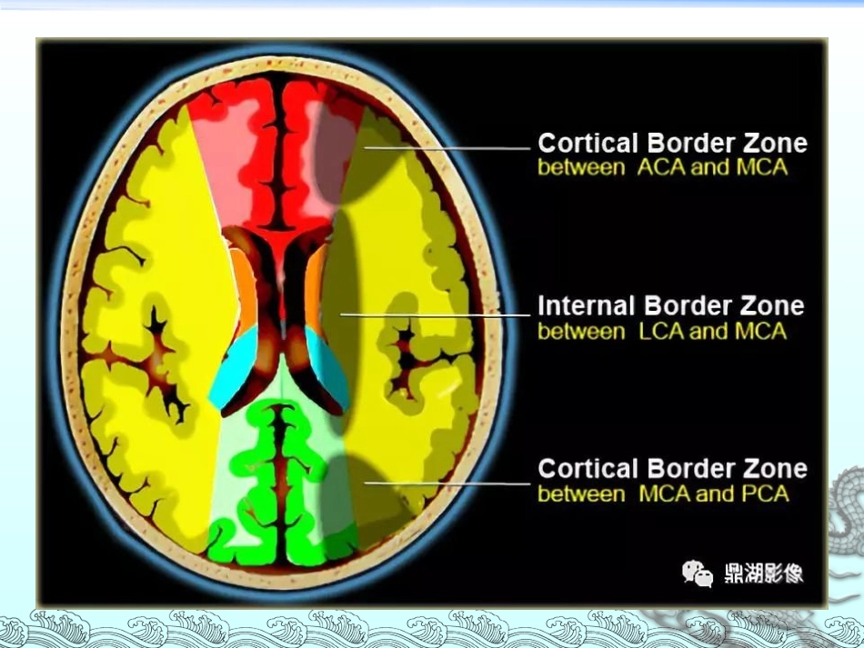分水岭脑梗死_第3页