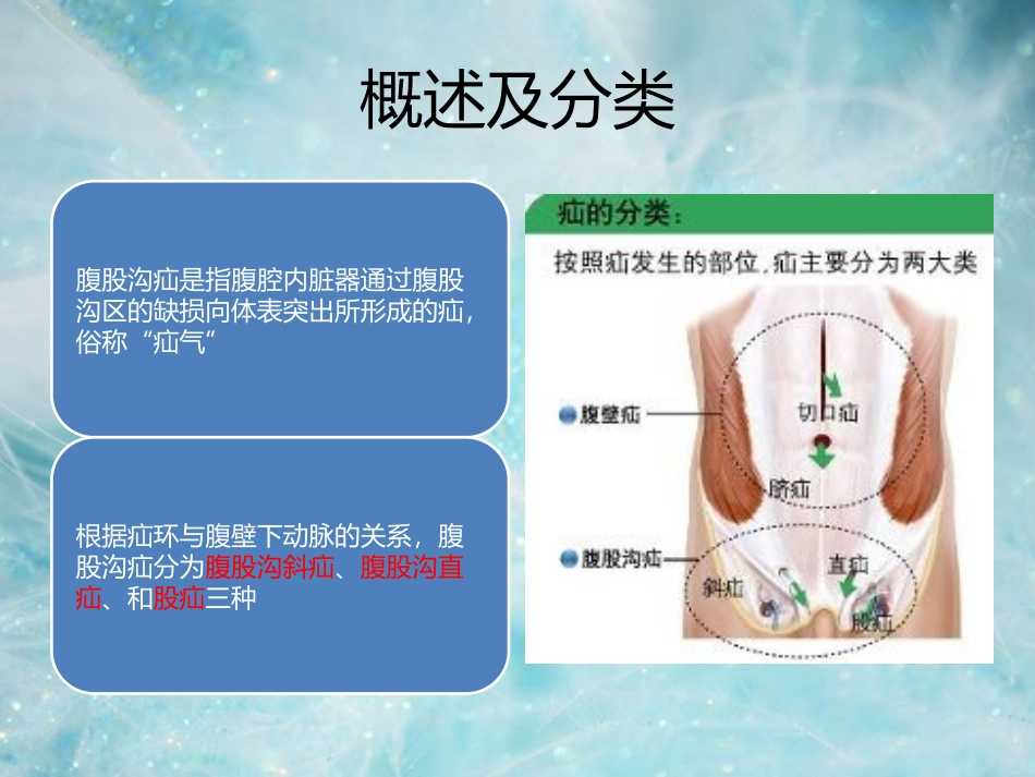 腹股沟疝的新进展_第2页