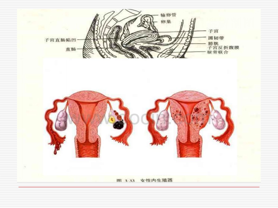 腹腔镜下卵巢囊肿剥除术._第3页