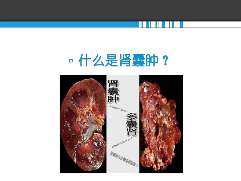 腹腔镜下肾囊肿切除术_第2页