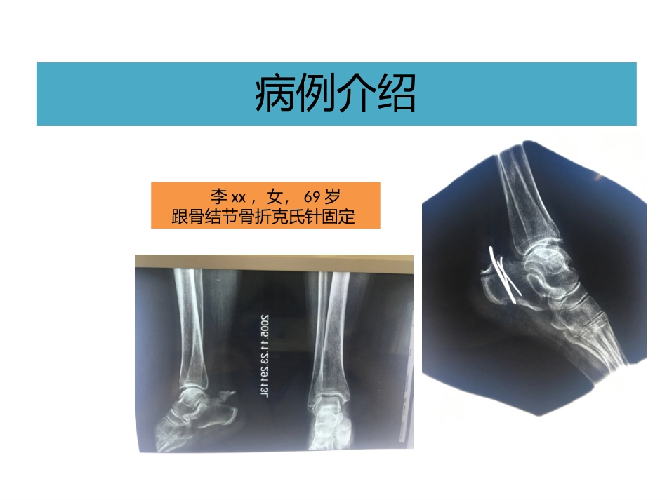 跟骨结节骨折_第2页