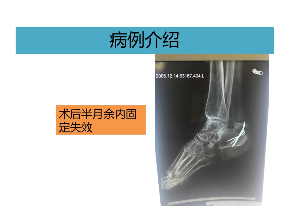 跟骨结节骨折_第3页