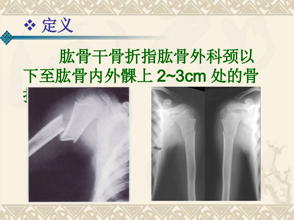 肱骨干骨折课件_第2页
