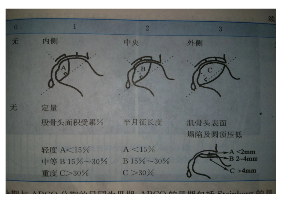 股骨头坏死国际分期_第3页