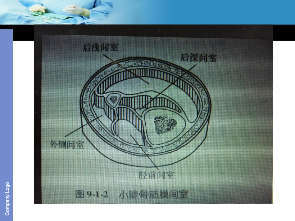 骨筋膜室综合征的护理_第3页