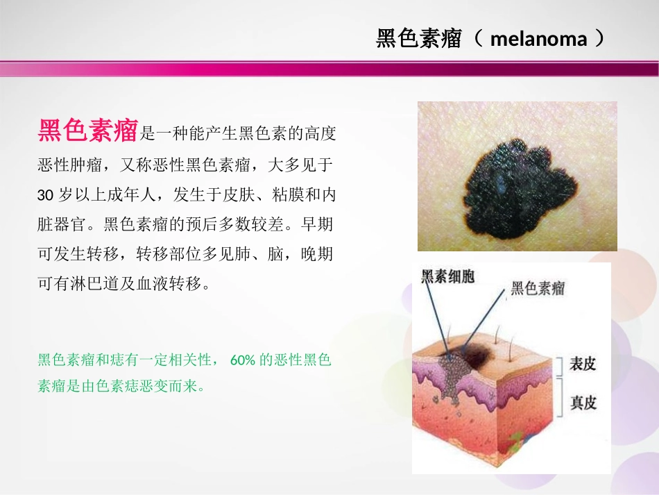黑色素瘤和黑痣的区别_第3页