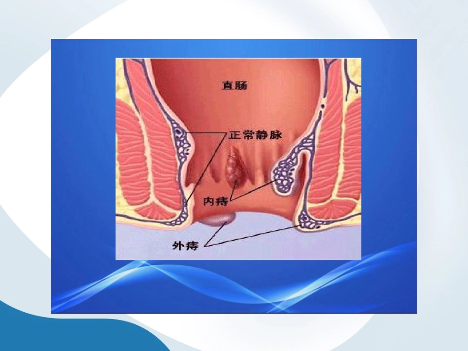混合痔术后护理_第3页