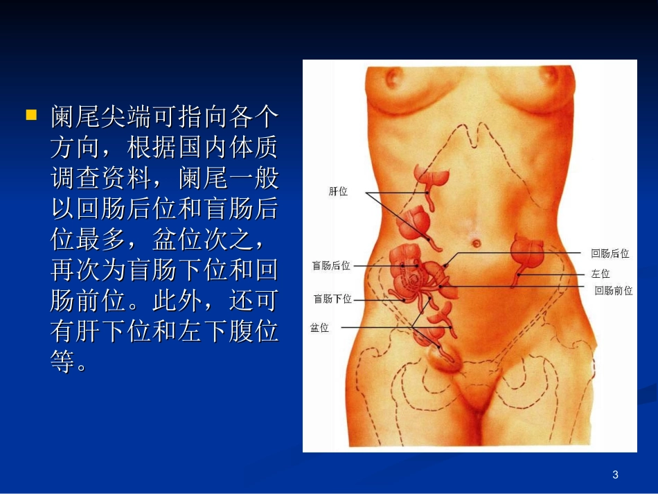 急性化脓性阑尾炎_第3页