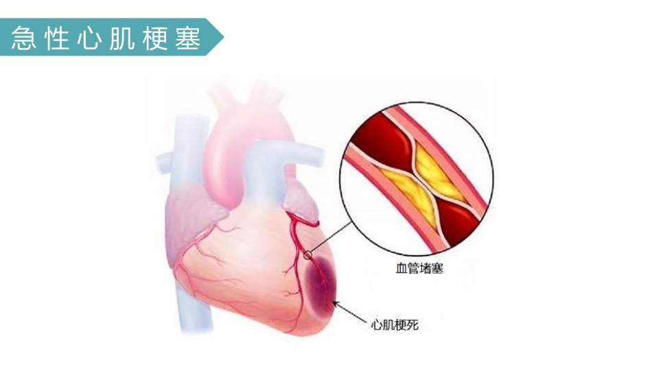 急性心肌梗塞_第3页