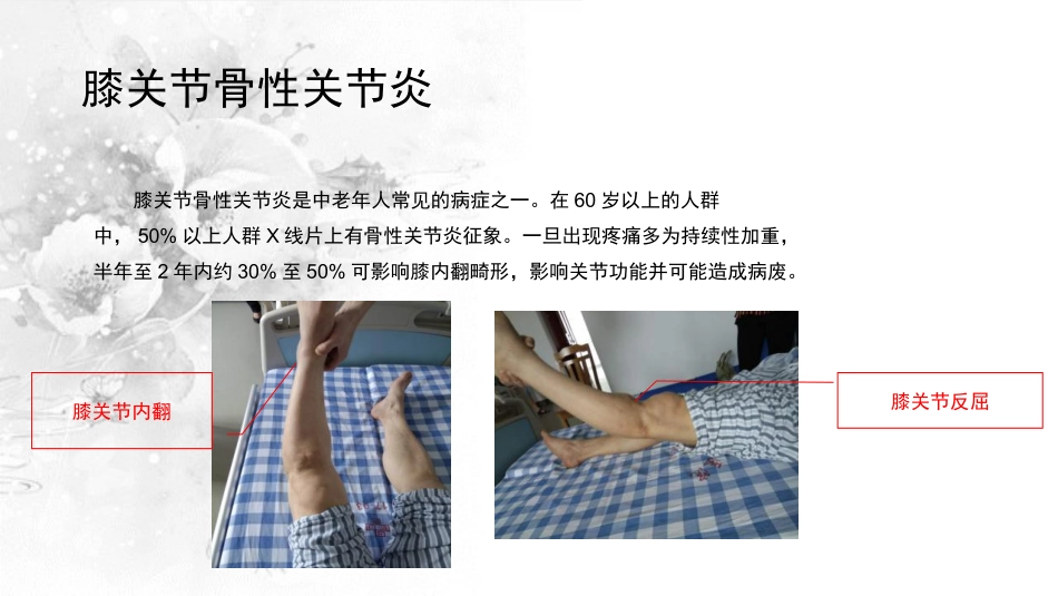 截骨术在不稳定膝关节的作用_第2页
