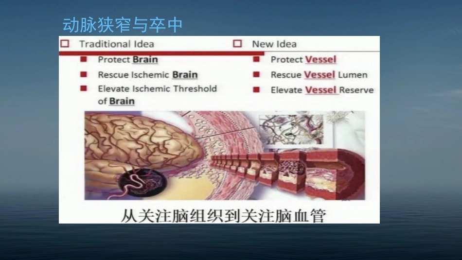 颈动脉狭窄概述和病例_第3页