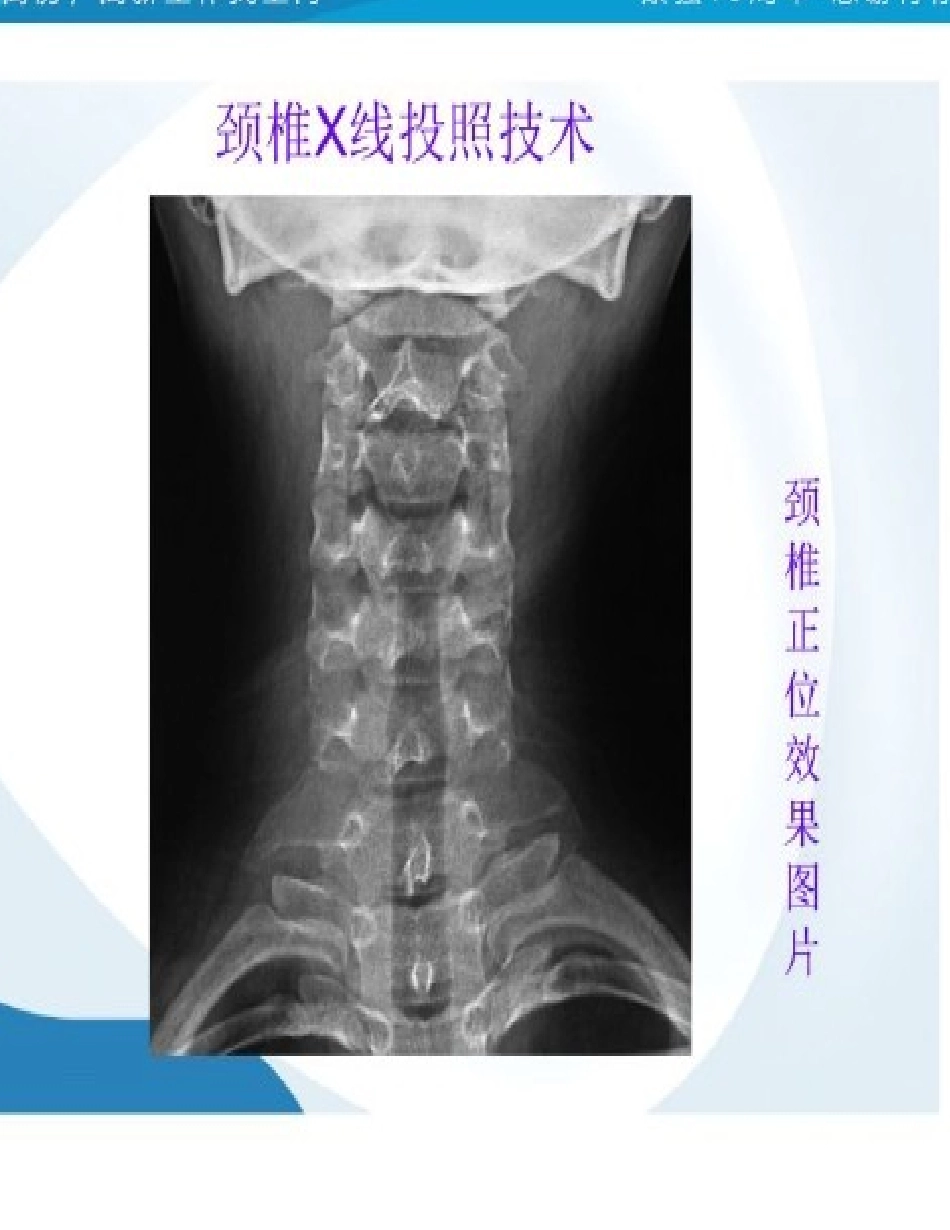 颈椎病的X光片读片技巧_第1页