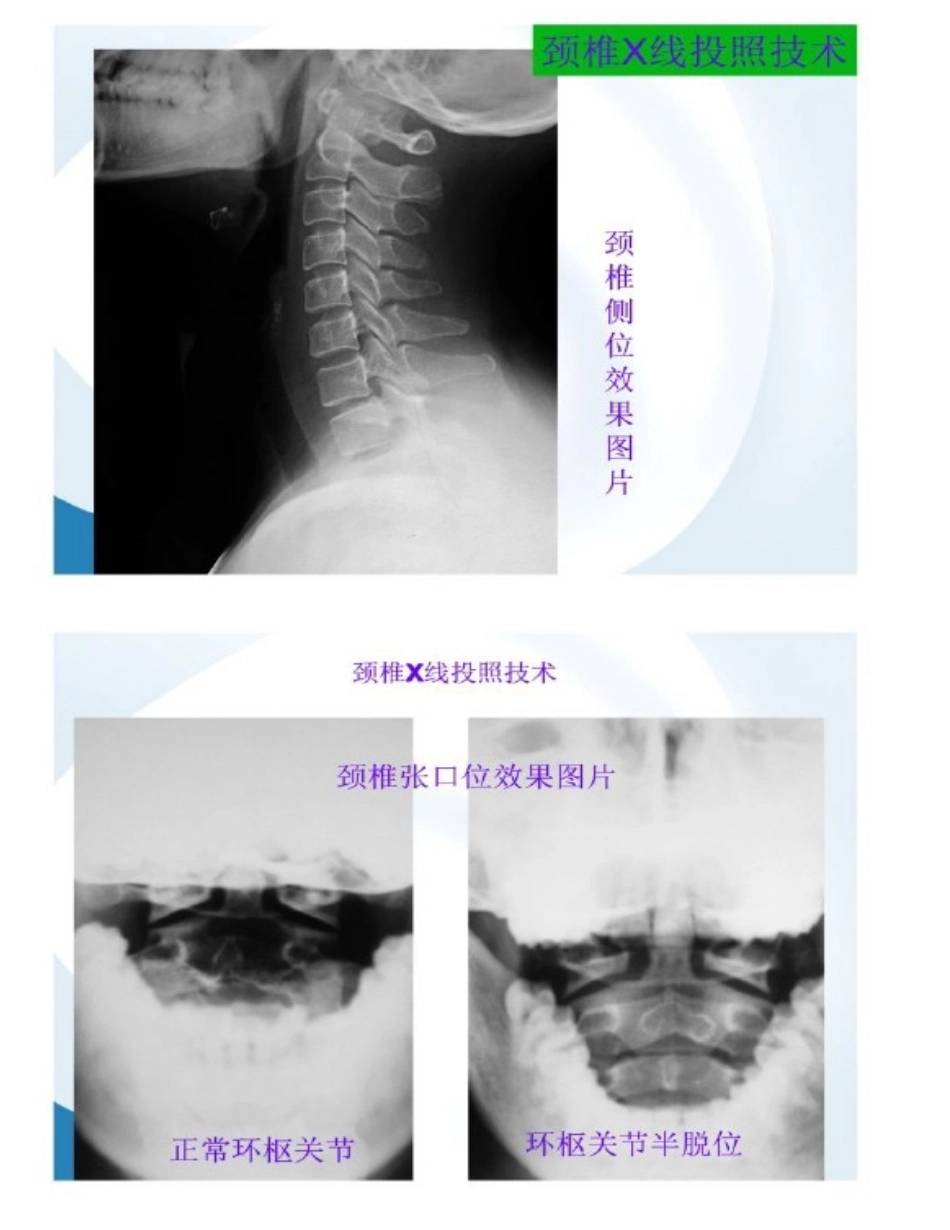 颈椎病的X光片读片技巧_第2页
