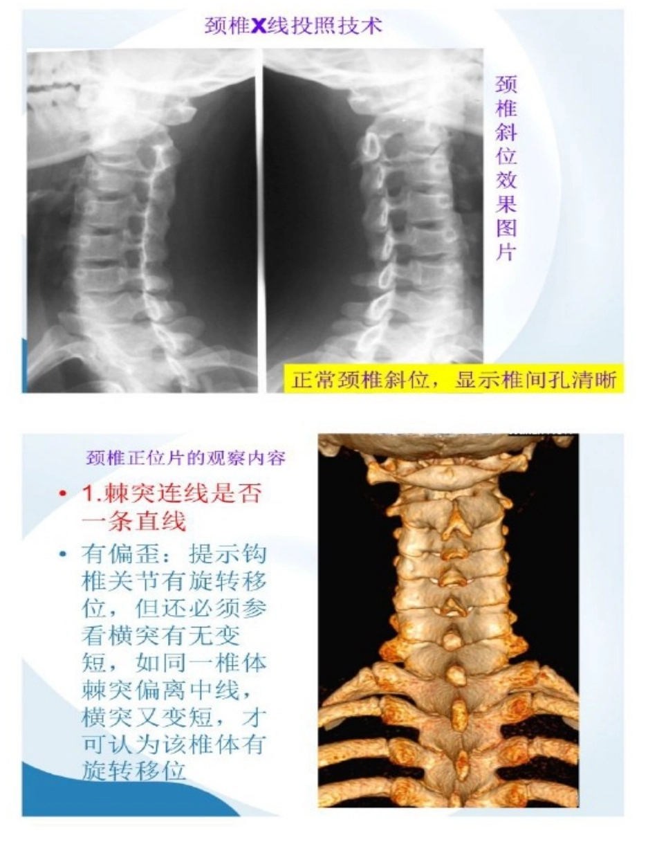 颈椎病的X光片读片技巧_第3页