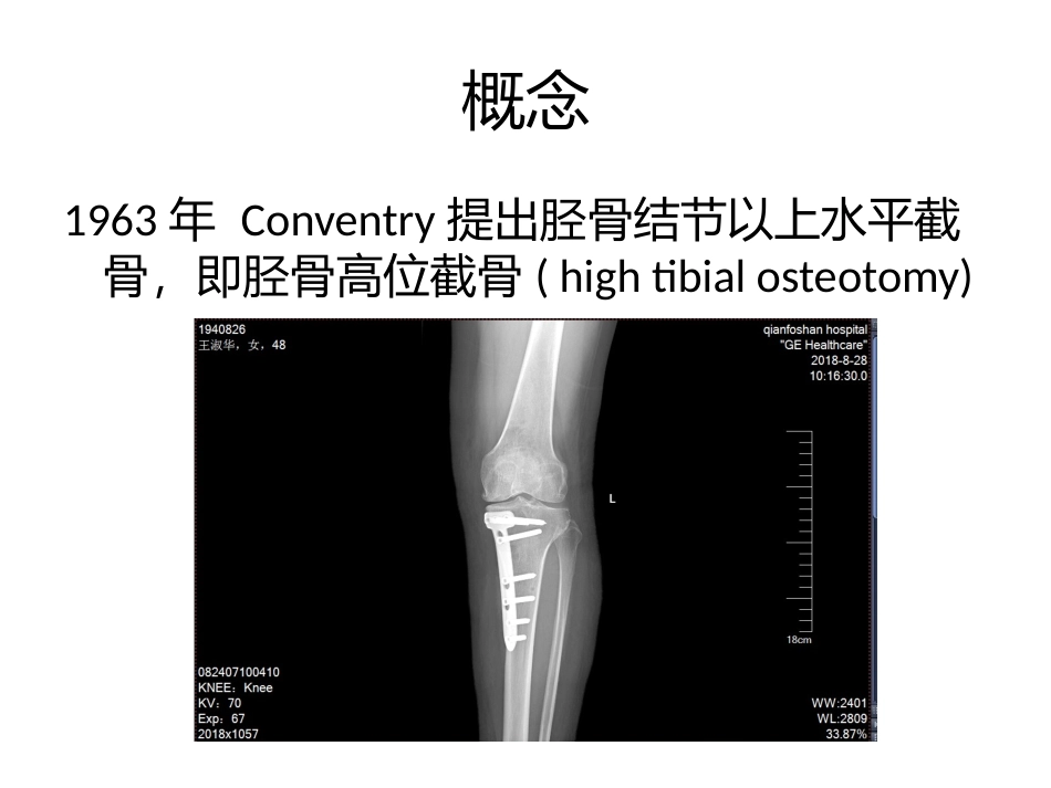 胫骨高位截骨术_第2页