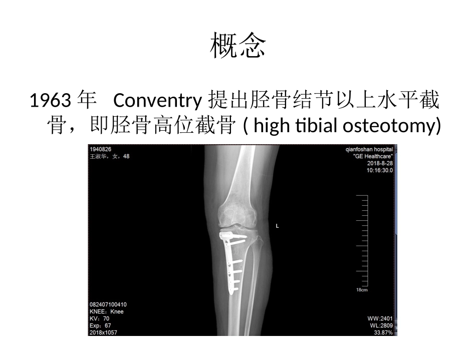 胫骨高位截骨术课件_第2页