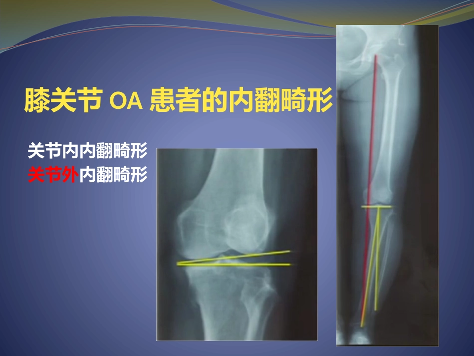 胫骨高位截骨治疗膝关节骨性关节炎_第2页