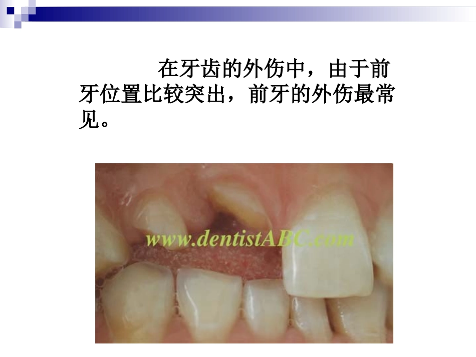 口腔科恒牙外伤的应急处置_第2页