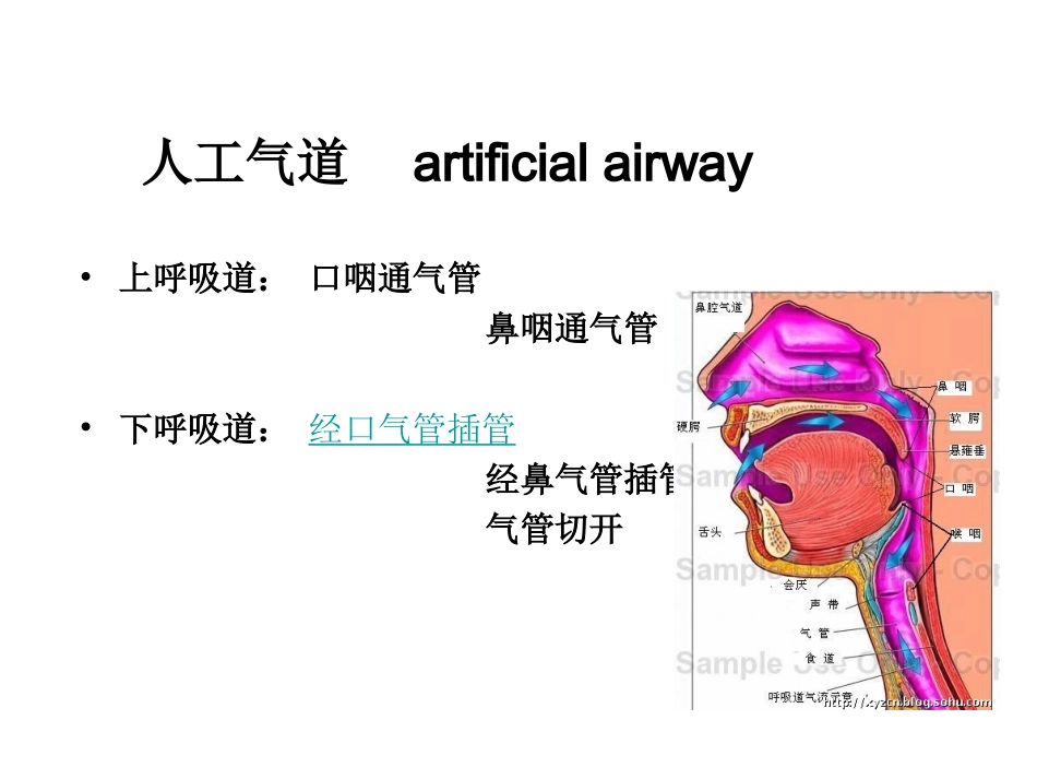 口咽通气管解读_第2页
