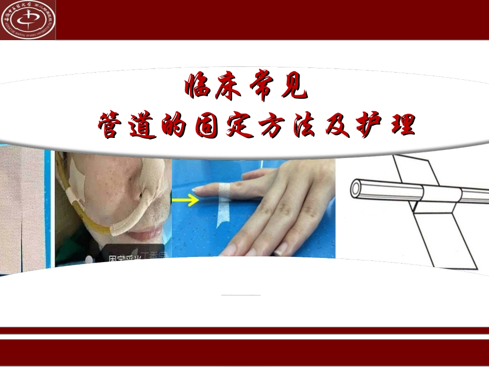 临床常见管道的固定方法及标识_第1页