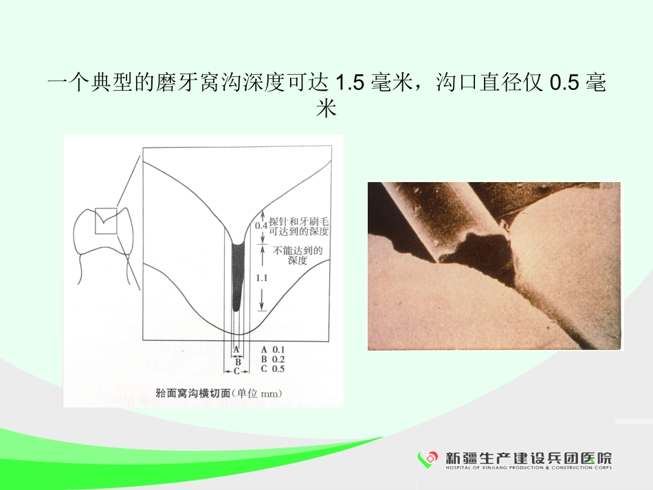 临床口腔预防技术窝沟封闭_第3页