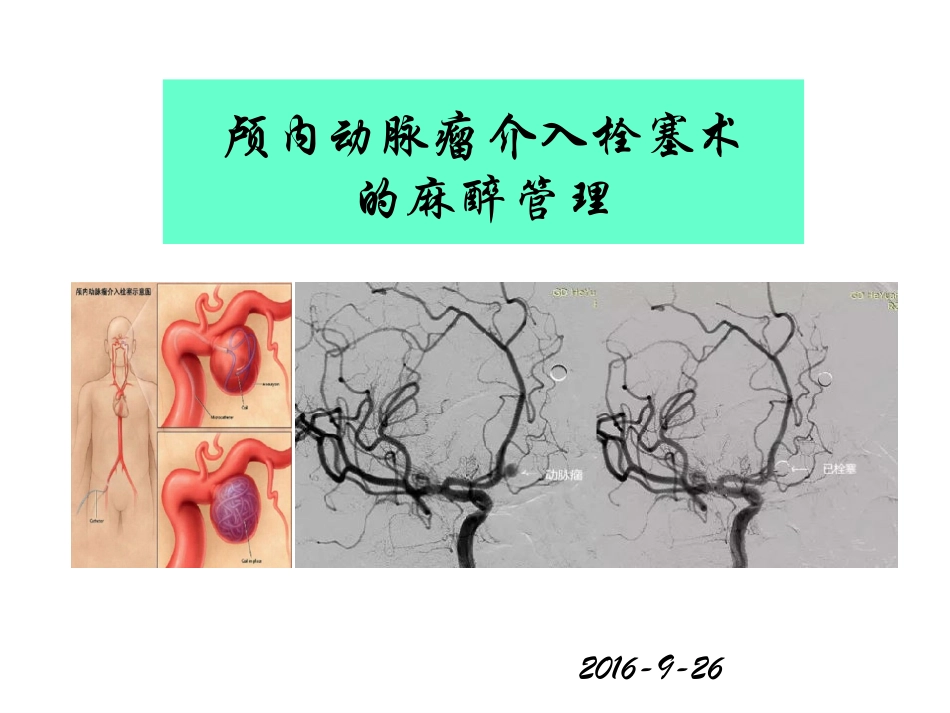 颅内动脉瘤介入栓塞术的麻醉管理_第1页