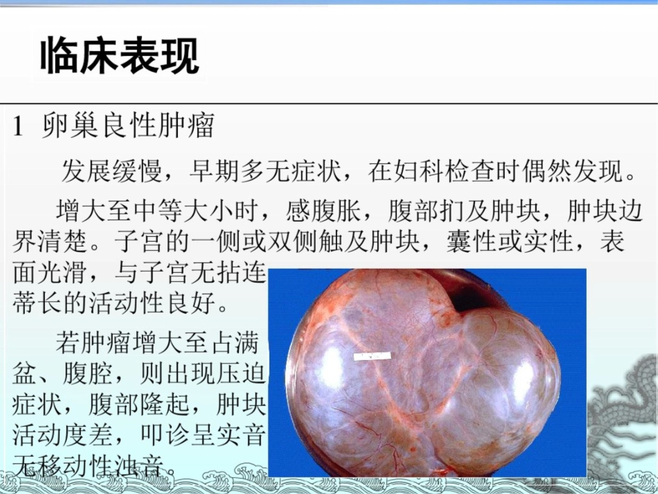 卵巢肿瘤课件最新_第3页