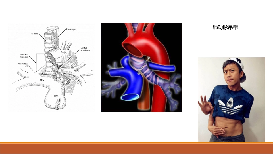迷走右锁骨下动脉_第3页