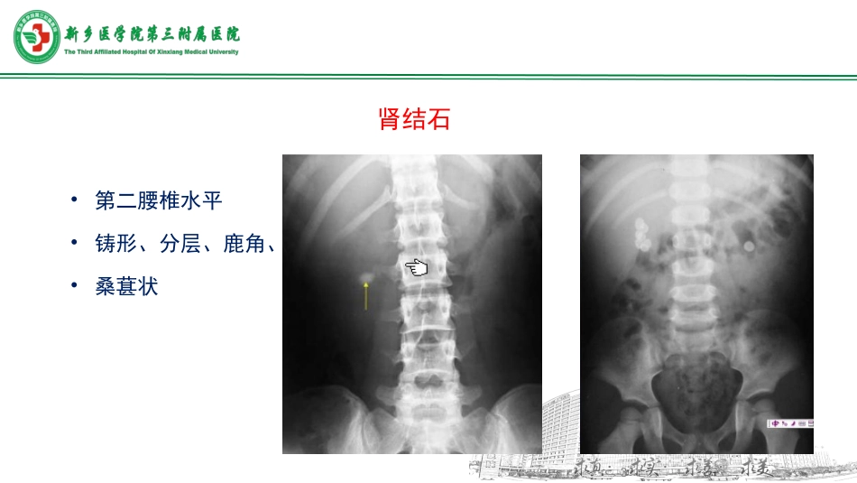 泌尿系结石的影像学表现潘瑞洋_第3页