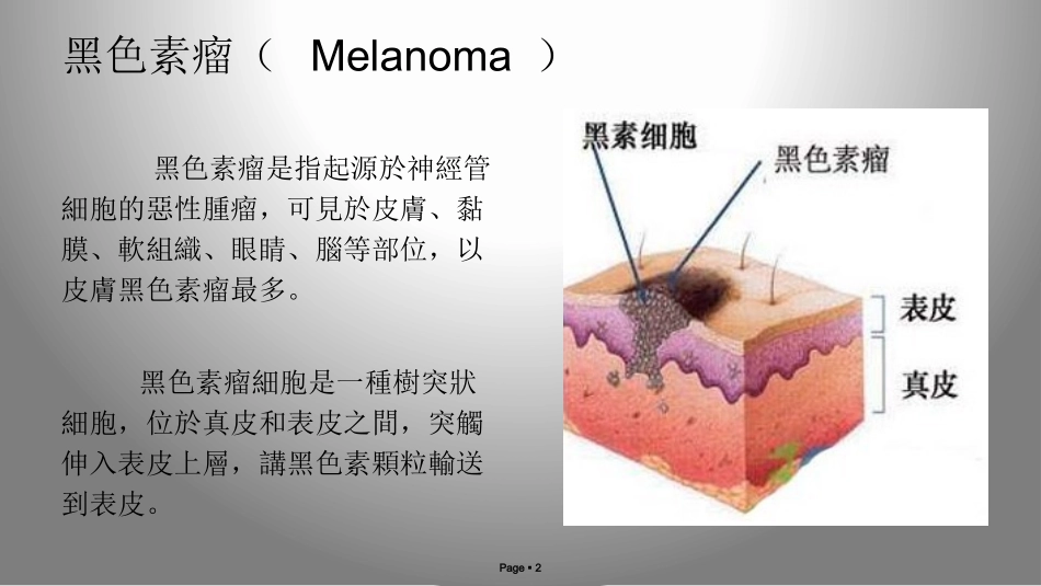 皮肤黑色素瘤_第2页